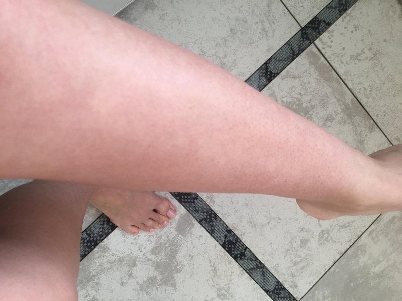 Чому з'являються червоні плями після гоління ніг? І як цього уникнути?